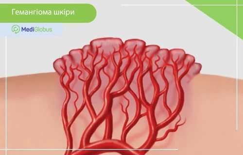 що таке гемангіома шкіри анатомічна ілюстрація гемангіоми шкіри та її будови