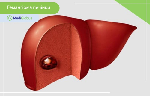 3D-зображення гемангіоми печінки