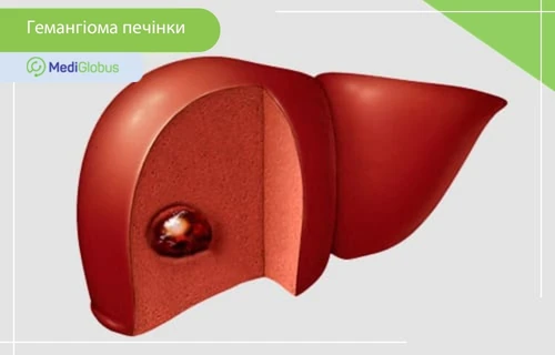 Гемангіома печінки у дітей 3D-зображення гемангіоми печінки