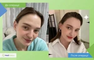 Ліпографтінг - робота Джу Квона Доктор Джу Квон - фото до і після ліпографтінгу