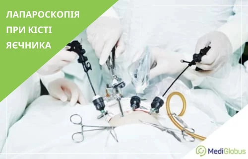 laparoscopic-surgery-for-overian-cyst-ukr лапароскопічна операція з видалення кісти яєчника