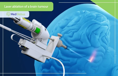 laser ablation of brain tumour