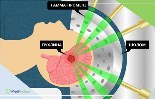 Лікування метастазів в головному мозку схема радіохірургії Gamma Knife — гамма-промені фокусуються на пухлині в головному мозку