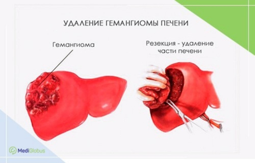 удаление гемангиомы печени Схематическое изображение гемангиомы печени и удаления опухоли