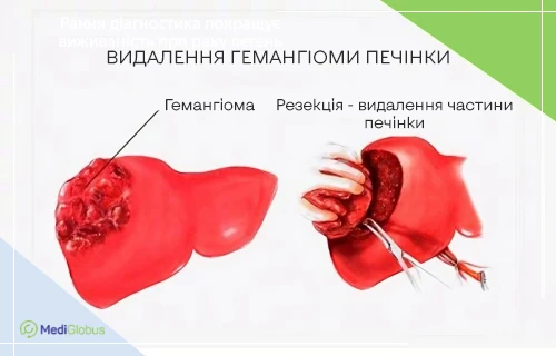 видалення гемангіоми печінки схематичне зображення гемангіоми печінки і видалення пухлини