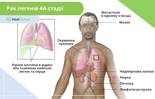 Інфографіка: Рак легенів, 4-та стадія