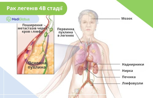 Рак легенів 4Б стадії Інфографіка: 4Б стадія раку легенів