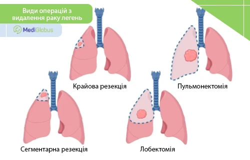 хірургічне лікування раку легень схематичні зображення різних видів операцій при раку легень