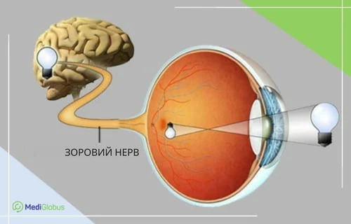 Що таке неврит зорового нерва