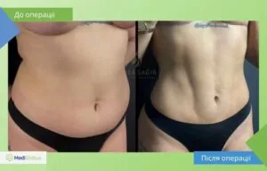 Ліпосакція - робота Омера Сагіра Омер Сагір фото до після ліпосакції