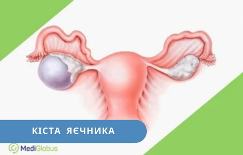 ovarian-cyst-ukr-2 лікування кіст яєчника