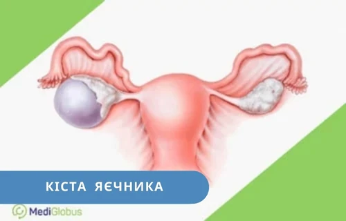 лікування кіст яєчника