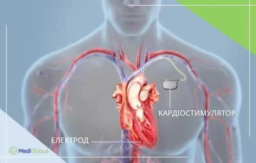 pacemaker_installation_abroad-uk встановлення кардіостимулятора за допомогою робота да вінчі за кордоном