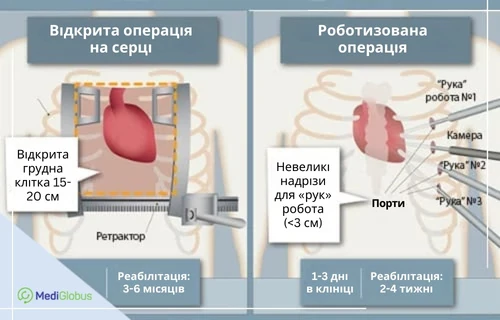 robotic_vs_open_surgery-uk аортокоронарне шунтування з роботом да вінчі за кордоном