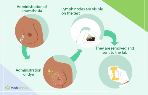 sentiel node biopsy of breast cancer