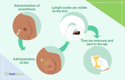 sentiel node biopsy of breast cancer