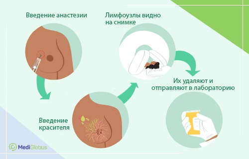 гистологическое исследование лимфоузлоа молочной железы