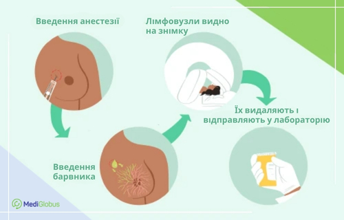 Проведення біопсії сигнального лімфовузла Інфографіка «Біопсія сторожового лімфовузла». Показано схеми введення анестезії та барвника в груди, сканування («лімфовузли видно на знімку») та видалення вузлів для відправки до лабораторії.