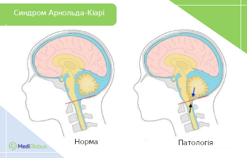 порівняння нормальної анатомії мозку та патології при синдромі Арнольда‑Кіарі