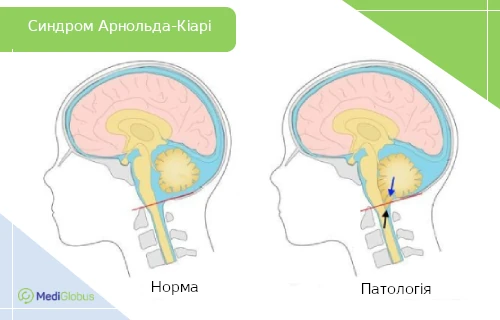 що таке синдром Арнольда‑Кіарі порівняння нормальної анатомії мозку та патології при синдромі Арнольда‑Кіарі