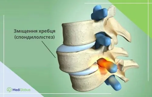 Зміщення хребця спондилолістез