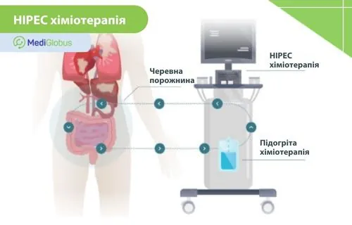 хіміотерапія HIPEC при раку шлунка Подальше лікування раку шлунка HIPEC терапією