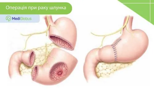 Ендоскопічна резекція — види операції при раку зображення шлунка до та після хірургічного втручання