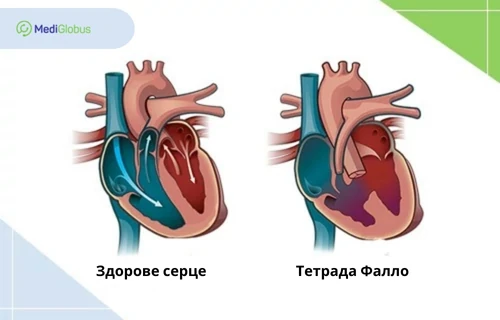 лікування тетради фалло
