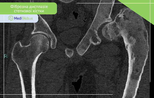 лікування фіброзної дисплазіїї стегнової кістки фіброзна дисплазія стегна на КТ
