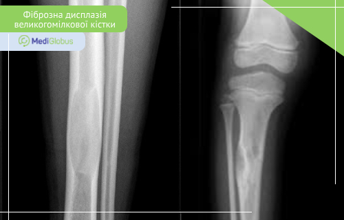 лікування фіброзної дисплазії великогомілкової кістки фіброзна дисплазія великогомілкової кістки на КТ