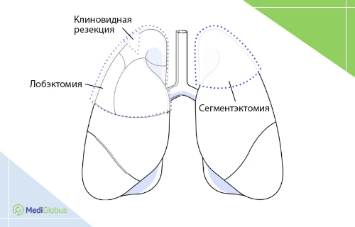 виды операций на легких