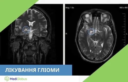 what-is-high-grade-and-low-grade-glioma-uk лікування гліоми за кордоном