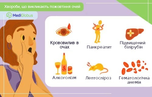 про що говорить пожовтіння очей