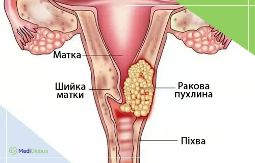 зображення пухлини шийки матки схематичне зображення жіночої полової системи із пухлиною розташованою в області шийки матки