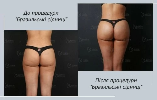 bbl_estetika_bursa_ukr бразильська підтяжка сіднииць клініка естетік інтернешнал бурса