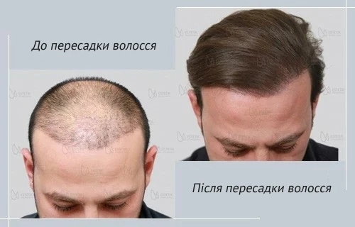 hair_transplant_estetika_bursa_ukr пересадка волосся клініка естетік інтернешнал бурса