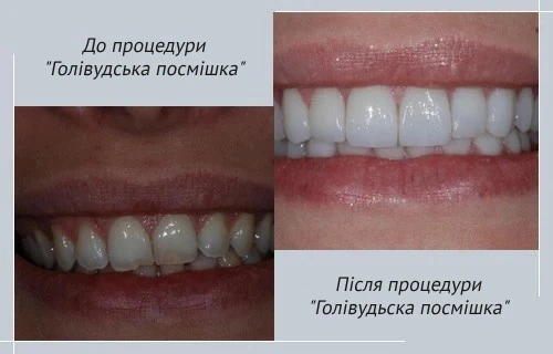 hollywood_smile_estetika_bursa_ukr голівудьска посмішка клініка естетік інтернешнал бурса