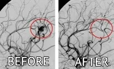 beforeafter_cyberknife_eng_1 cyberknife brain treatment before after pictures