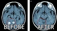 beforeafter_cyberknife_eng_2 cyberknife brain treatment before after pictures