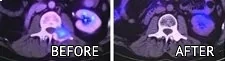 beforeafter_cyberknife_eng_3 cyberknife brain treatment before after pictures