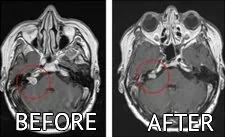 beforeafter_cyberknife_eng_4 cyberknife brain treatment before after pictures
