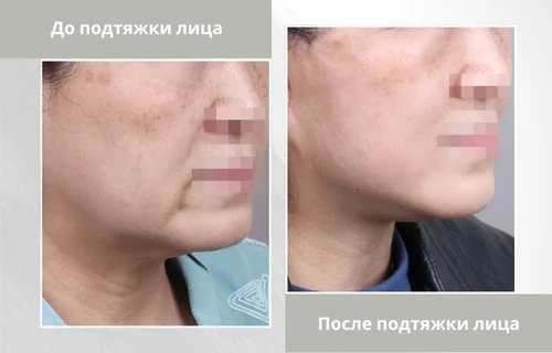 Photos-before-and-after-SMAS-Facelift-ru подтяжка лица в клинике Lienjang