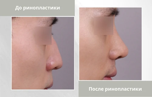 Photos-before-and-after-rhinoplasty-ru ринопластика клиника Lienjang