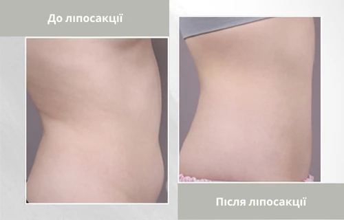 before-and-after-liposuction-photos-lienjang-uk ліпосакція в клініці Lienjang