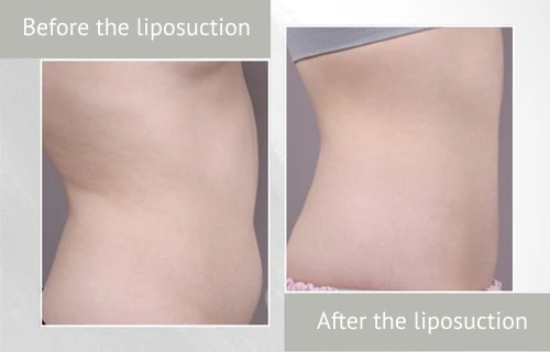 before_and_after_liposuction_photos_eng Lienjang liposuction before after
