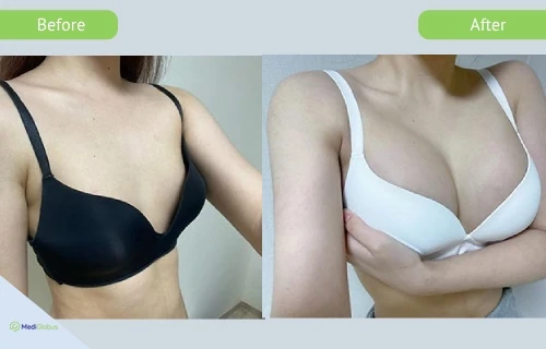breast_implants_girin_before_after_eng breast augmentation at girin hospital before after pictures