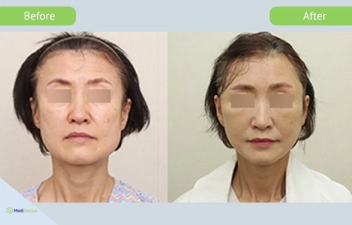facelift_girin_before_after_eng facelift at girin hospital before after pictures