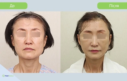 facelift_girin_before_after_ukr підтяжка обличчя в клініці гірін