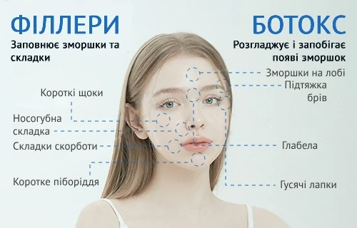 girin_botox_fillers_ukr порівняння філлерів і ботоксу в клініці гірін