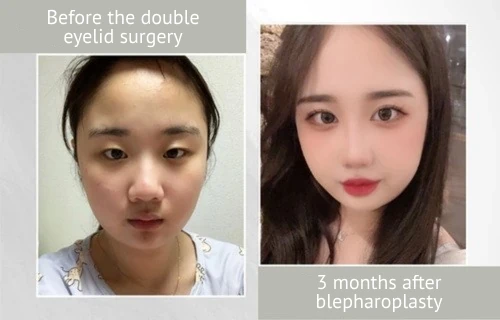 photos_before_and_after_blepharoplasty_eng Lienjang blepharoplasty before after